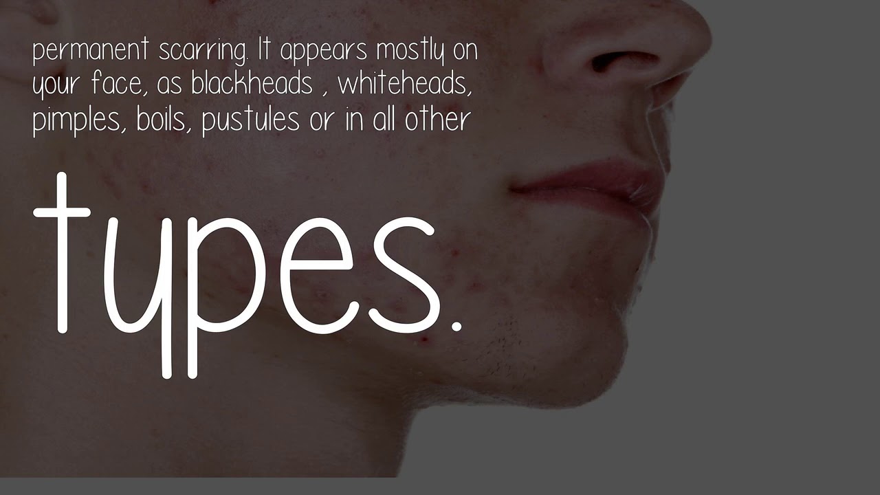 What Are Causes Of A Sudden Acne Breakout? YouTube