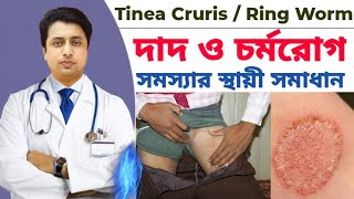 দাদ ও চুলকানি দূর করার উপায় | দাদ ও হাজার চিকিৎসা | Fungal Infection | Tinea Corporis | দাদের ওষুধ screenshot 2