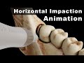 Innovative 3D Animation: Horizontal Impacted Mandibular Third Molar Extraction