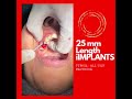 Transinus iIMPLANTS #thedentalspecialists #hyderabad#viral #shorts #ytshorts #dentalartistry