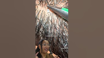 multiple hairs stuck in one pore. #reaction #hairremoval #ingrownhairremoval #wax