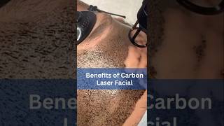 Carbon Laser Facial Benefits