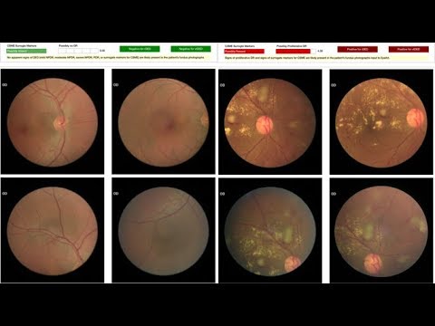 Classification of Diabetic Retinopathy Detection using cnn Matlab Project Source Code