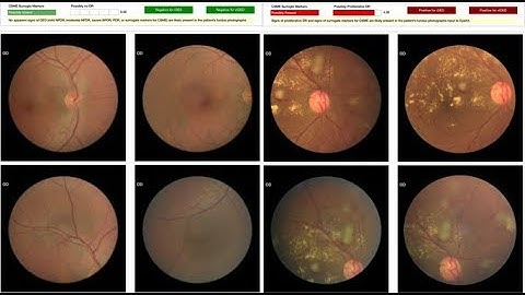Classification of Diabetic Retinopathy Detection using cnn Matlab Project Source Code