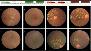 Classification of Diabetic Retinopathy Detection using cnn Matlab Project Source Code