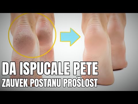 Video: Ispucale Pete - Kako Ih Popraviti I Hidratizirati?