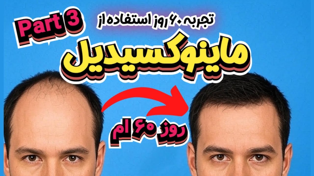 تجربه استفاده از ماینوکسیدیل، روز ۶۰ ام