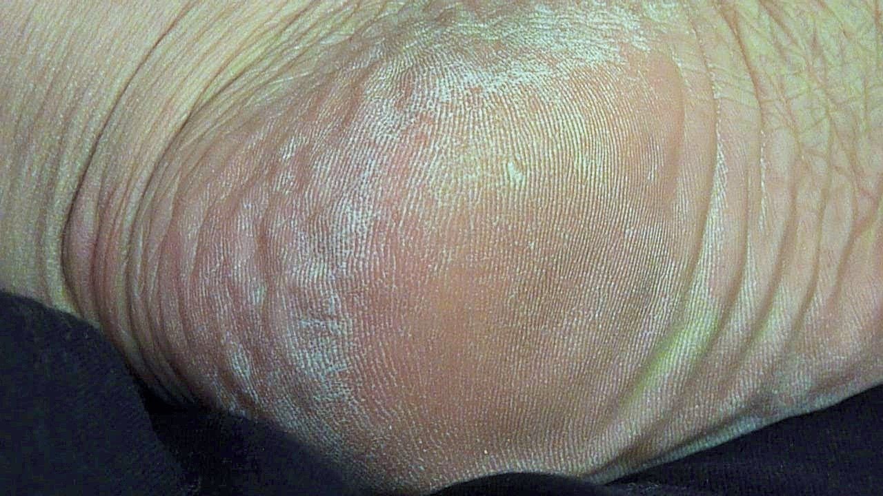 REMOVE DRY CRACKED SKIN ON FEET 