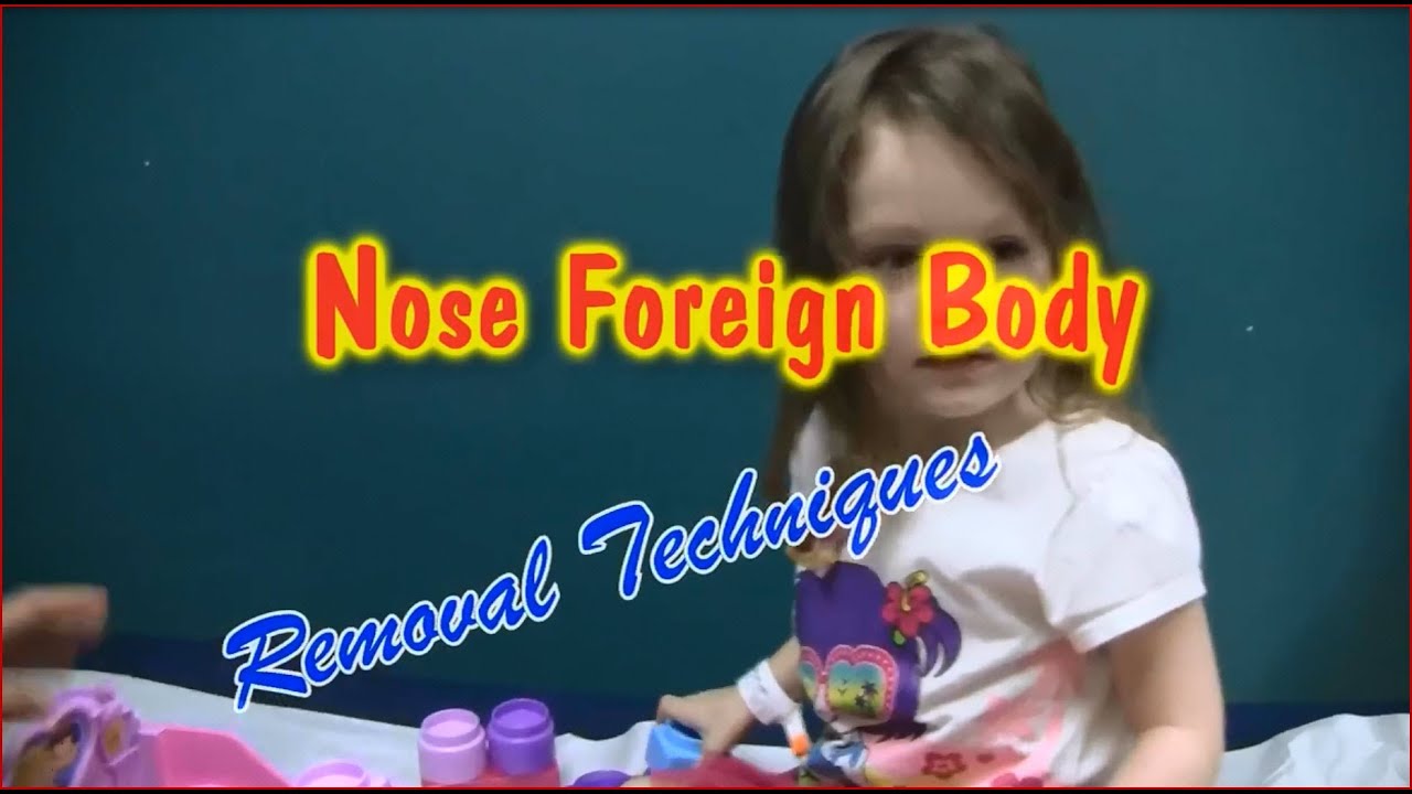 Nasal Foreign Body Removal Techniques YouTube