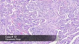Organizing Pneumonia