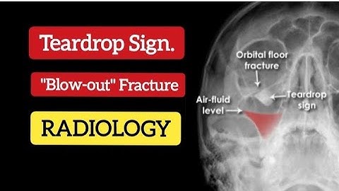 Blowout Fracture - Teardrop Sign - Basic Radiology