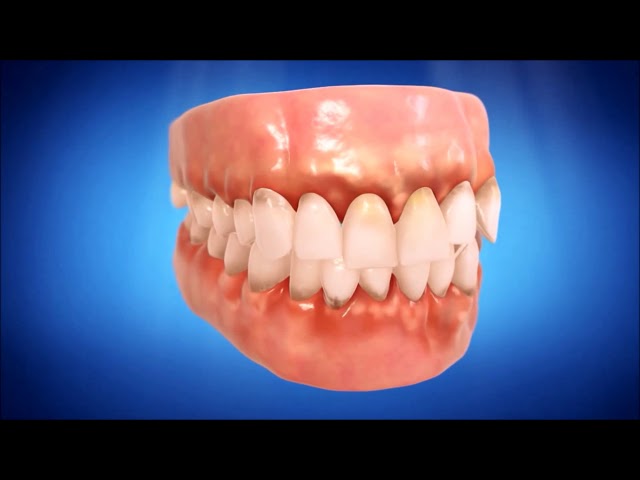 Invisalign Clear Braces at The Oaks Dental Clinic