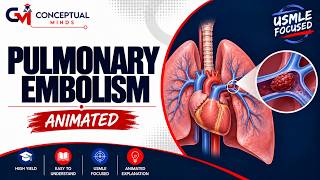 Pulmonary Embolism | Diagnosis, ECG & Treatment | USMLE Quick Review Animation