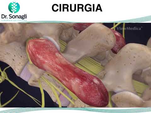 Artrodese Lombar - Indicação Cirurgica, Tecnica e Pós Operatório lombardo illuminazione