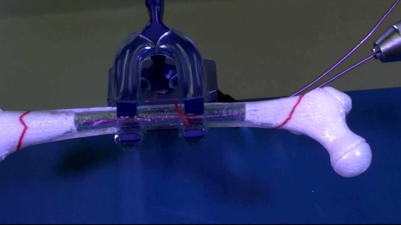 Интрамедуллярный остеосинтез дистальных переломов бедренной кости у детей с применением TEN