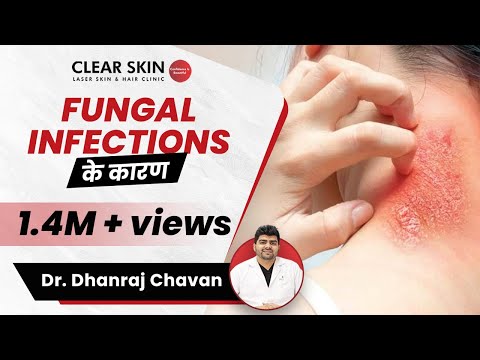 Fungal Infection Causes In Hindi (फंगल इन्फेक्शन के कारण) | ClearSkin, Pune