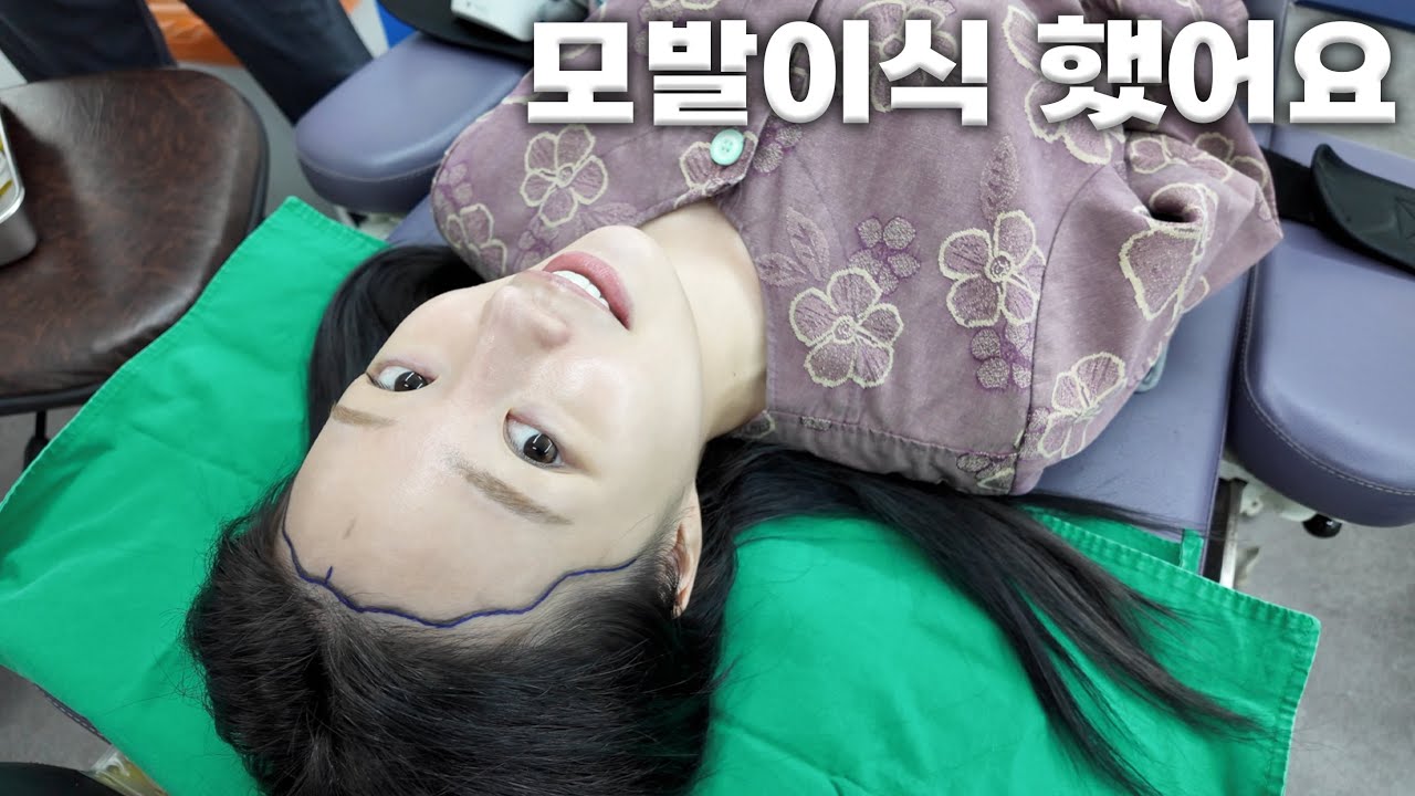헤어라인 모발이식👼🏻 수술과정/한달차 후기📝 (M자 이마•여자 헤어라인•비절개•회복 과정)ㅣMINCARONG