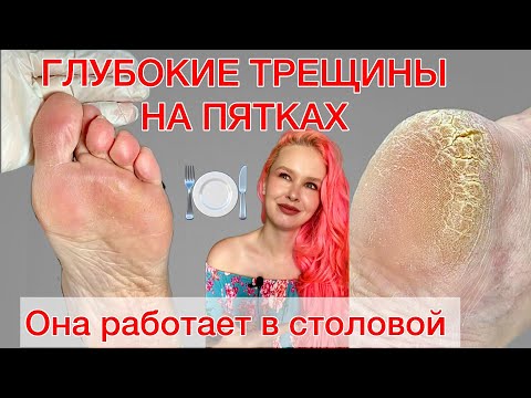 ОНИХОЛИЗИС | ТРЕЩИНЫ НА ПЯТКАХ | СТЕРЖНЕВАЯ МОЗОЛЬ | АНАЛИЗ ОБУВИ #алена_лаврентьева #подолог