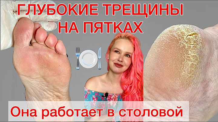 ONYCHOLYSIS | CRACKS ON HEELS | CALLUS | SHOES ANALYSIS #alena_lavrentieva #podologist