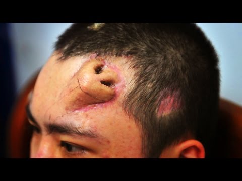 Нос на лбу вырастили китайские пластические хирурги