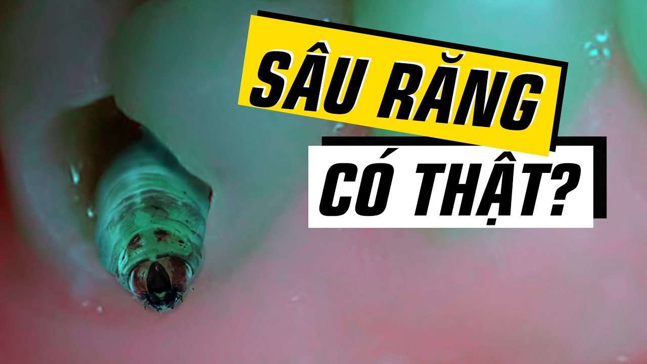 #372 Bóc Trần Sự Thật Về..."Con Sâu Răng"!!!