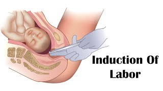 Induction Of Labor - Artificial Rupture Of Membranes (Amniotomy) -