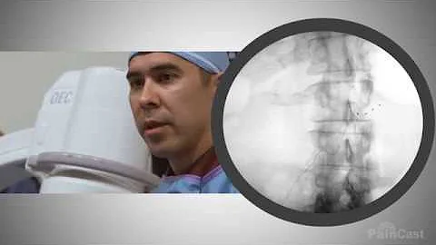 Dorsal Root Ganglion Stimulation Lead Placement