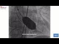 Myval in bicuspid anatomy