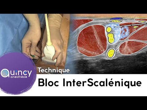 Vidéo: Intercalé dans le terme médical ?