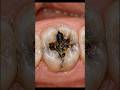 Deep Black Cavity Filled Like New 🦷 | Satisfying Dental Restoration #shorts
