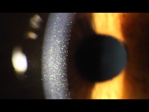 RAINBOW GLITTER Cornea Endothelial Dystrophy