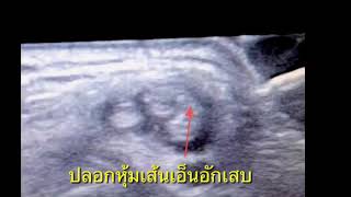 ปวดข้อมือ เนื่องจากปลอกหุ้มเส้นเอ็นอักเสบ