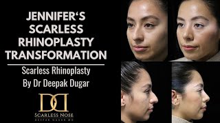 Jennifer's Scarless Nose™ Rhinoplasty Nosejob, Beverly Hills, Dr. Deepak Dugar, Plastic Surgery