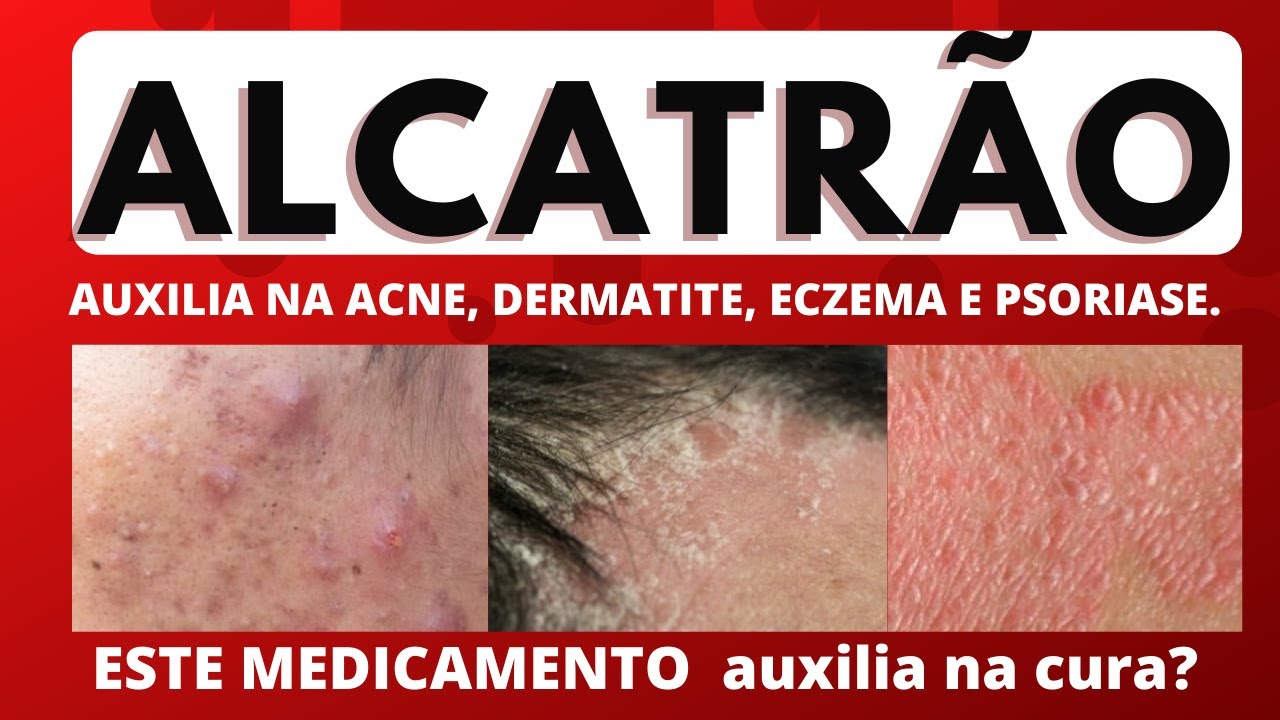 AlCATRÃO TÓPICO: Mecanismo de ação, indicação, contraindicação, reações ...