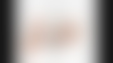 Robotic right anterior sectionectomy for HCC in a cirrhotic patient | Narrated technical description