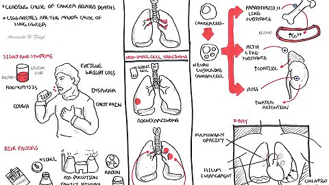 Lung Cancer - Overview