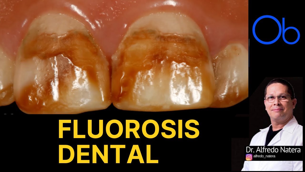 FLUOROSIS DENTAL  🦷 con Dr Alfredo Natera
