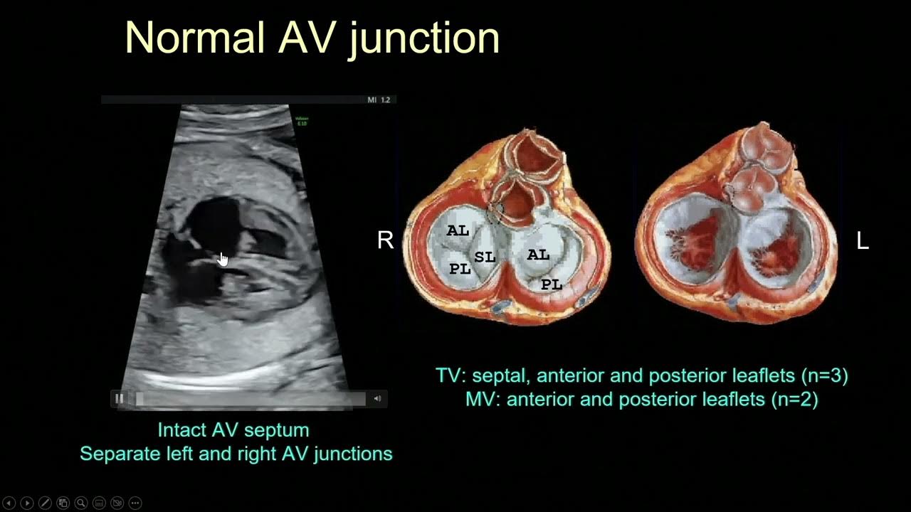 2024 Fetal Echocardiography Normal and Abnormal Hearts A Video CME