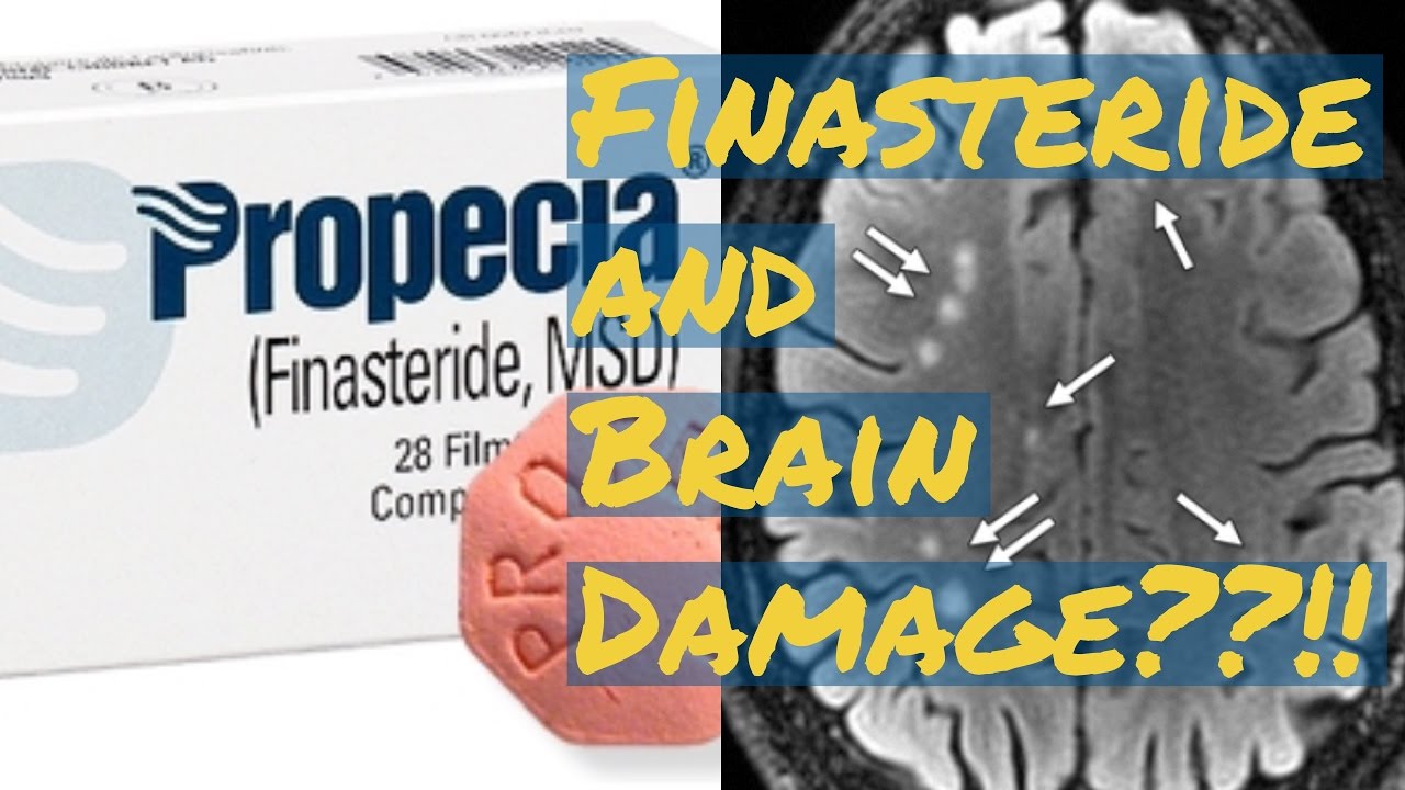 Finasteride Propecia Review Neurologicalin Damage Finasteride Propecia Review Neurologicalin Damage
