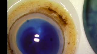 Dmek Preparation Liquid Bubble Dirisamer