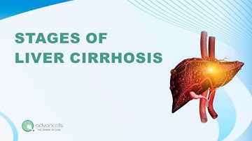 #LiverDisease | What are the 4 Stages of Cirrhosis of the Liver?