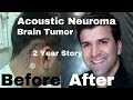 Acoustic Neuroma -  My experience of a brain tumor & brain surgery (30min)
