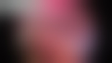 Pure Laparoscopic Right Hepatectomy CHC on HBV with right hepatic vein thrombosis (VV2)