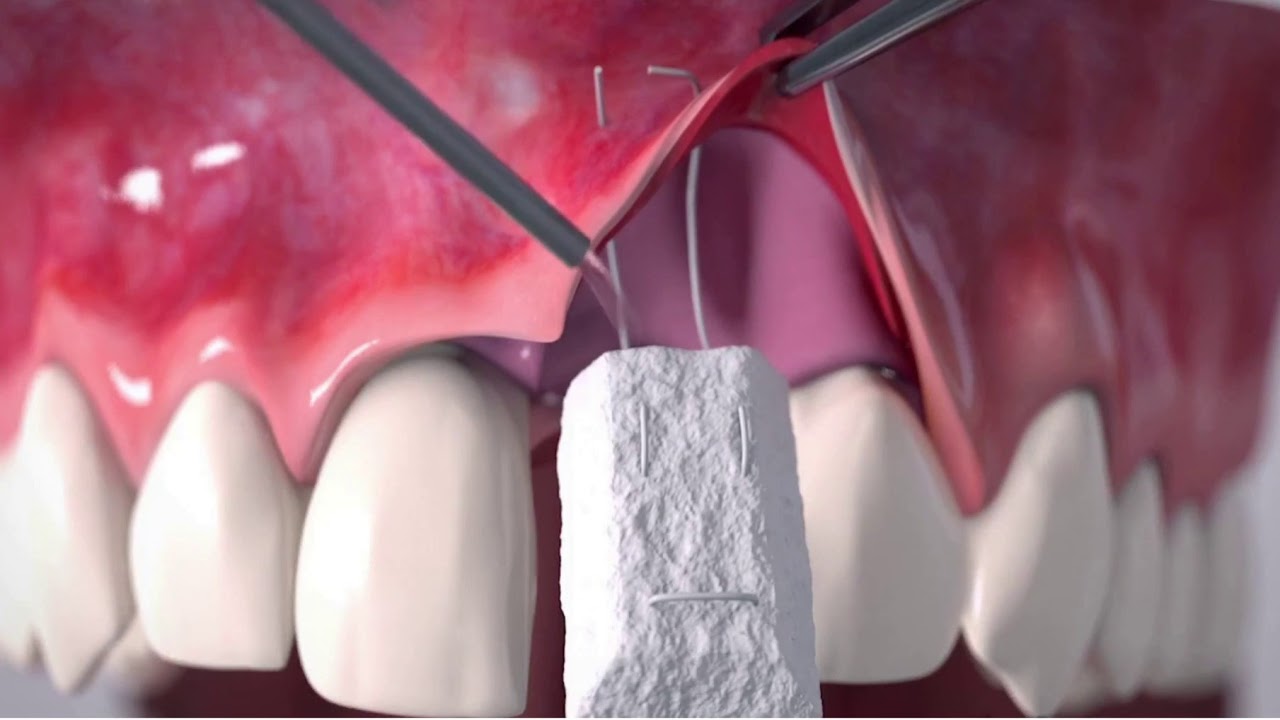 Soft tissue augmentation around a dental implant | Rajan Dental