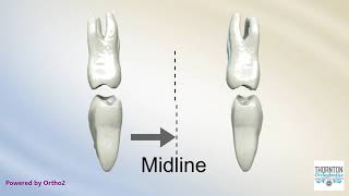 Posterior Crossbite with Functional Shift