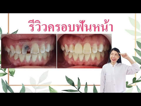 รีวิวครอบฟันหน้า