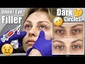 Under Eye Filler Injection for DARK CIRCLES | Alexandra Anele