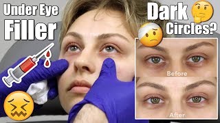 Under Eye Filler Injection for DARK CIRCLES