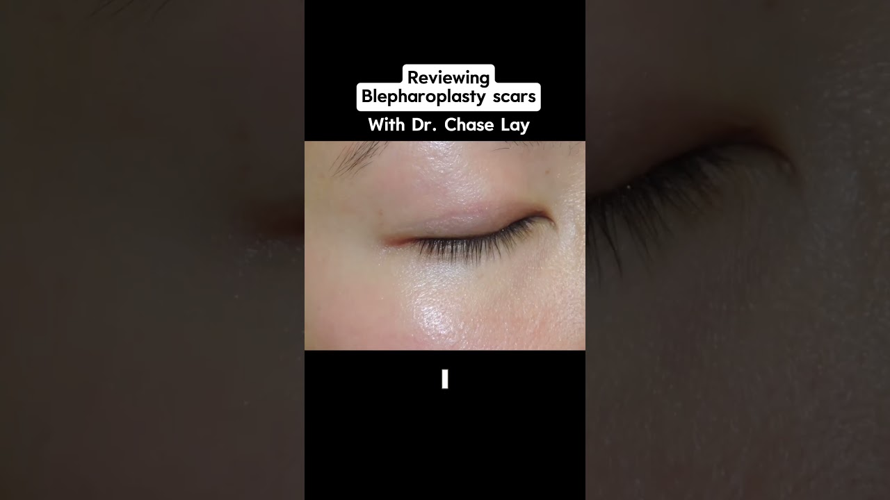 Reviewing Blepharoplasty Scars