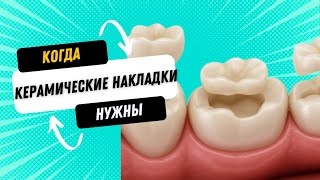 видео: Керамические накладки на зубы. Когда пломбы уже не достаточно.  картинка: Керамические накладки на зубы. Когда пломбы уже не достаточно.
